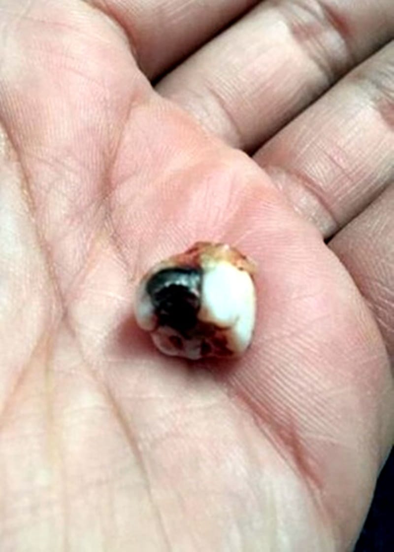 Homem leva tiro em SP durante roubo e é salvo por um dente.